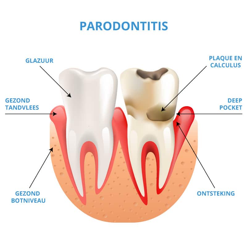 Luxe Regeneratie knal Parodontitis, een ontsteking veroorzaakt door bacteriën - Gebitszorg